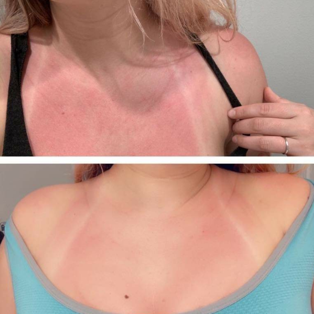 PREORDER ONLY ByeBye Stretch Marks,Mosquitos,Burns - Picture 13 of 16